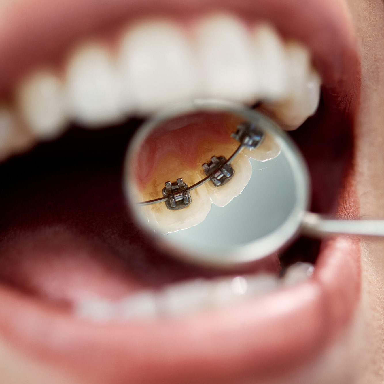 Close-up,Of,Female,Patient,Having,Check-up,Of,Dental,Braces,On