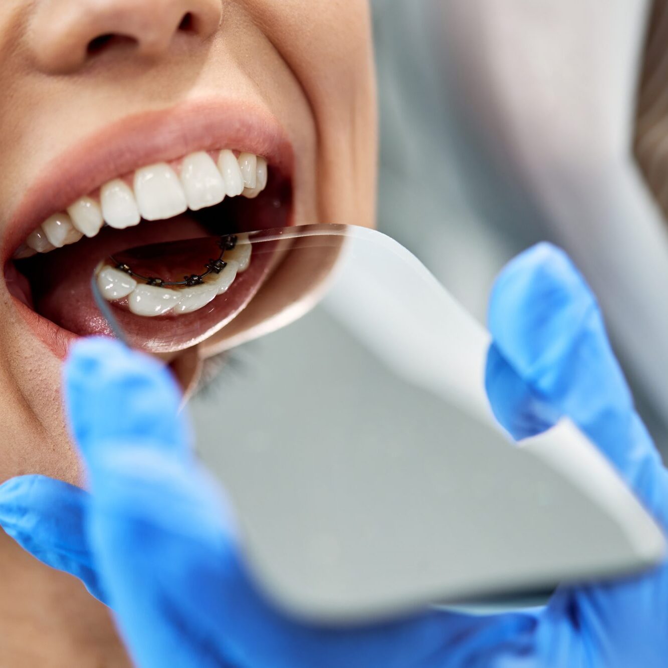 Close-up,Of,Orthodontist,Examining,Lingual,Braces,Of,Female,Patient,With